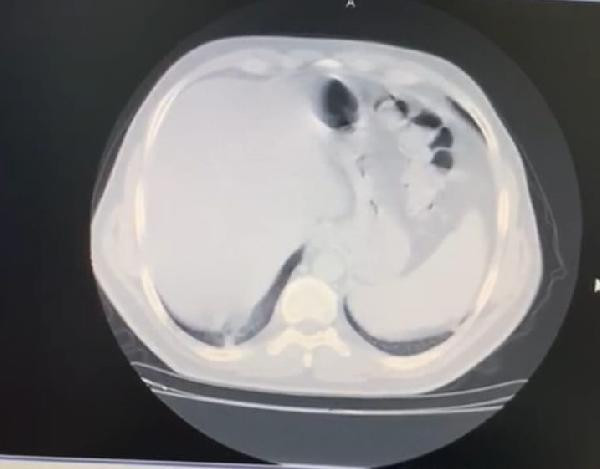 Koronavirüsü yenen doktor anlattı: Ciğerimin yüzde 70'ini kapladı - Resim : 1