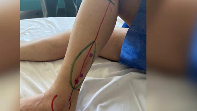 Kanser nedeniyle çene kemiği alınan hastaya bacak kemiğinden çene yapıldı