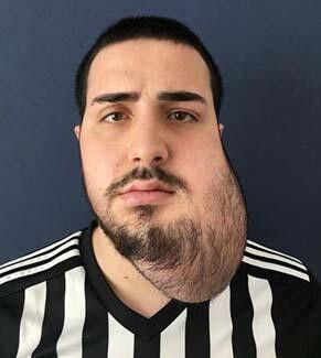 Çenesinden 420 gram tümör alındı, hayata yeniden döndü