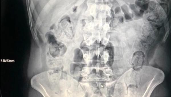 İranlı yolcuların midesinden 871 gram metamfetamin çıktı - Resim: 2