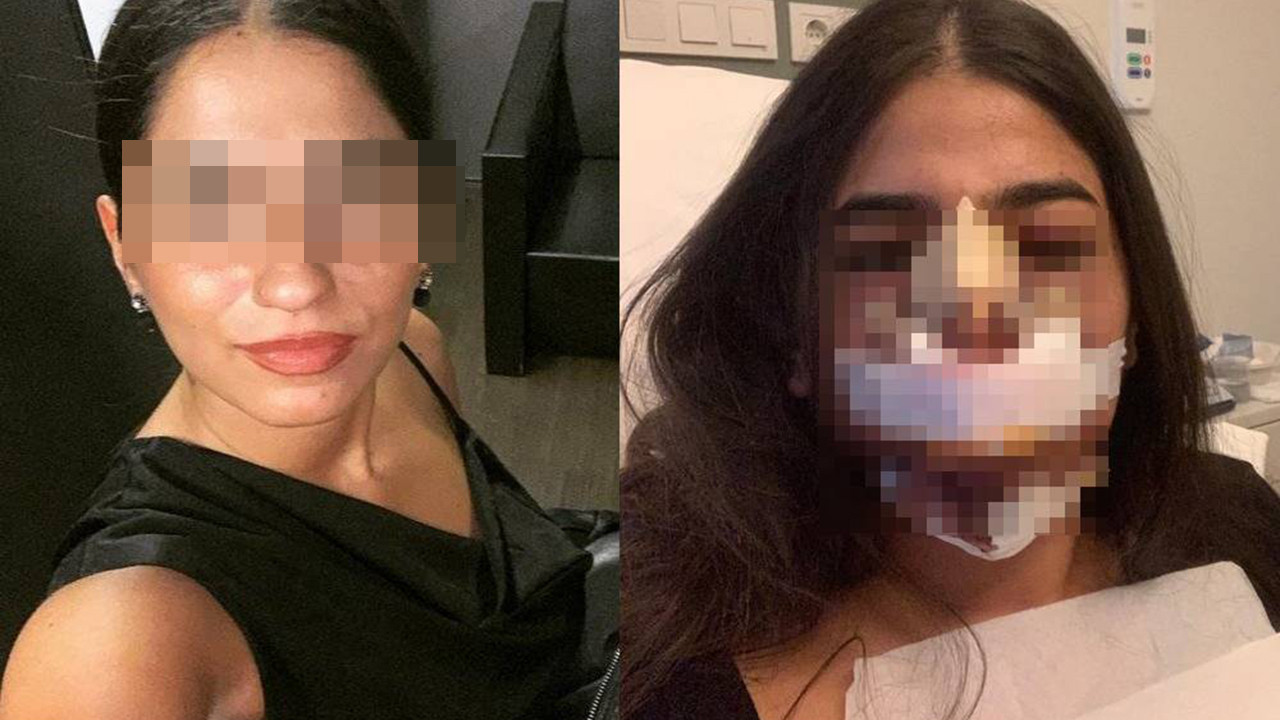 Tek isteği burun estetiği yaptırmaktı! Sonuç facia oldu