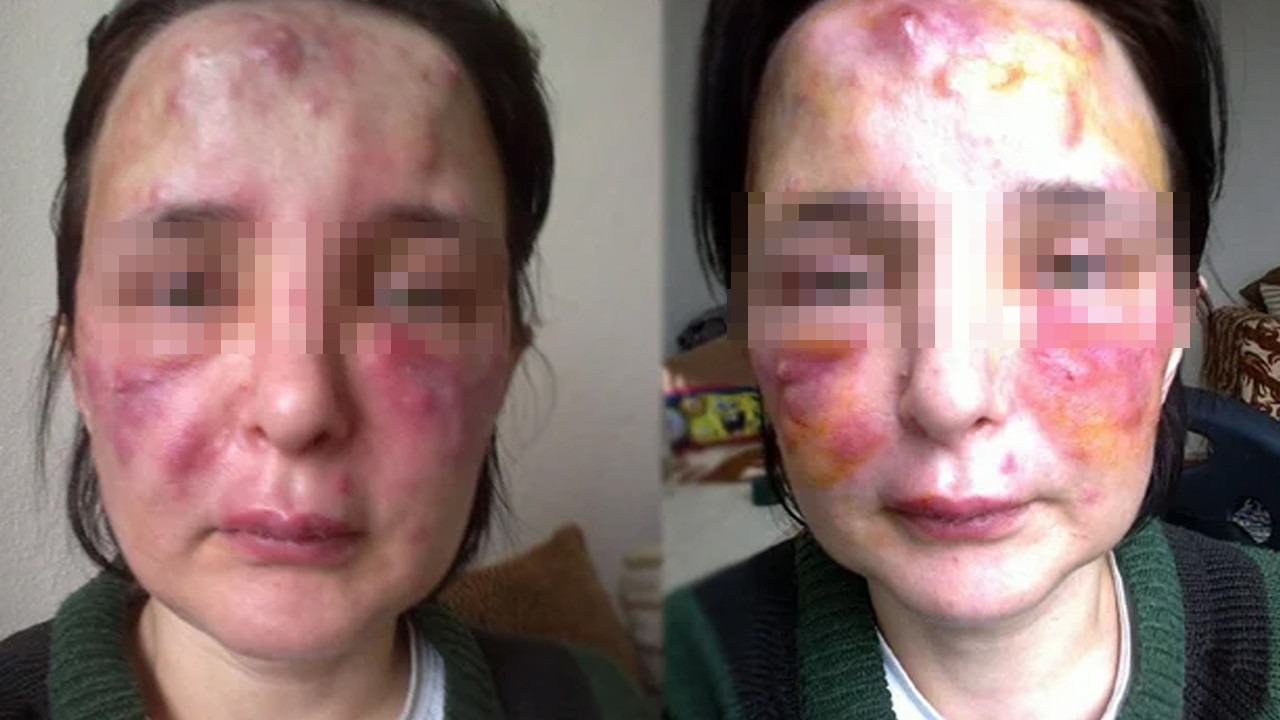 Yüzüne dolgu yaptığı kadının hayatını kararttı: Sahte doktorun cezası belli oldu