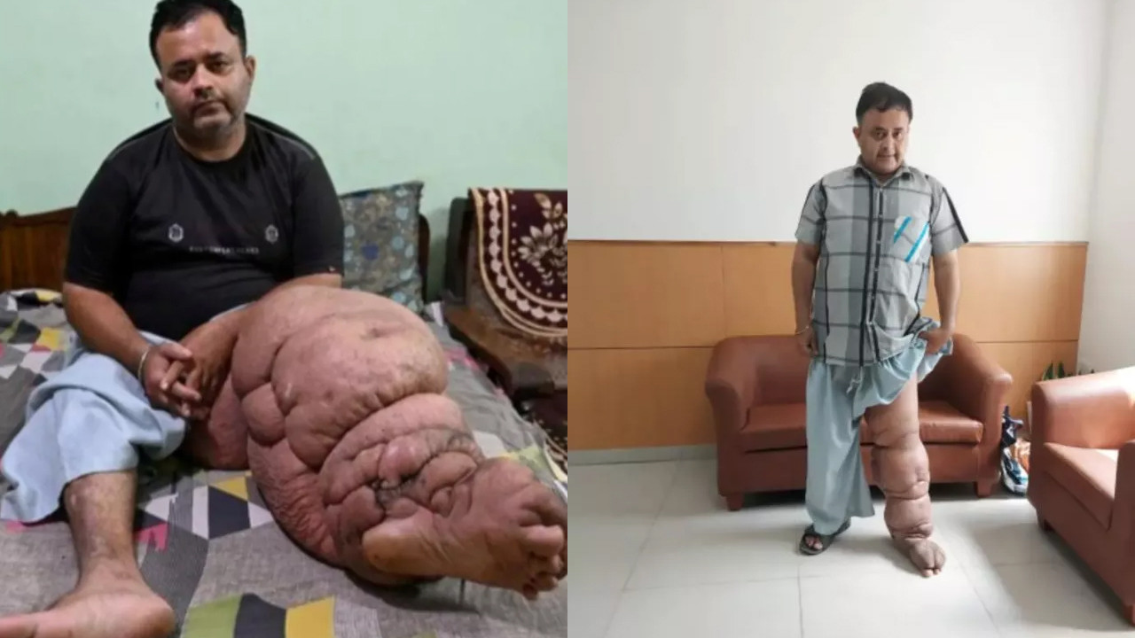 Sadece bir bacağı 98 kiloydu: O adam artık yürümeye başladı