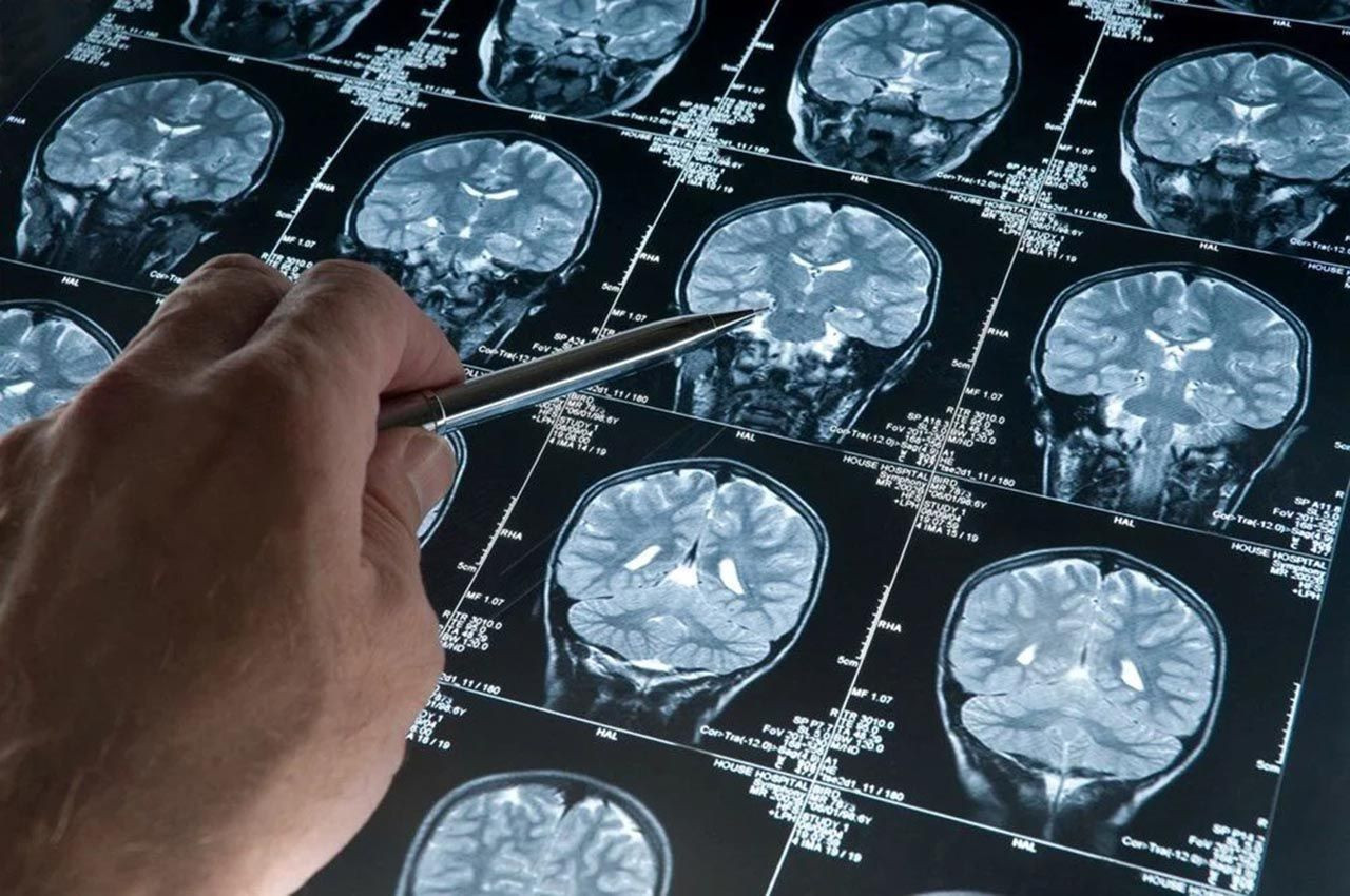30 yıllık araştırma: Alzheimer hastalığının genetik şifresi çözüldü - Resim: 1