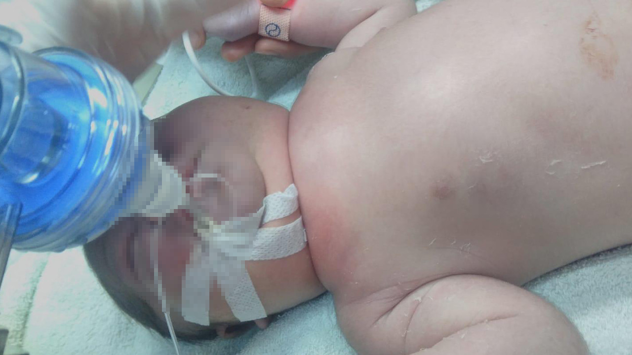 Hastanede korkunç iddia: Doğumda bebeğin köprücük kemiği kırıldı