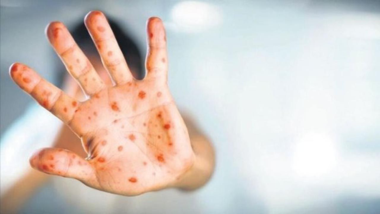 Türkiye'deki ilk vaka sonrası uzmanından maymun çiçeği uyarısı: İşte en riskli grup! - Resim: 2
