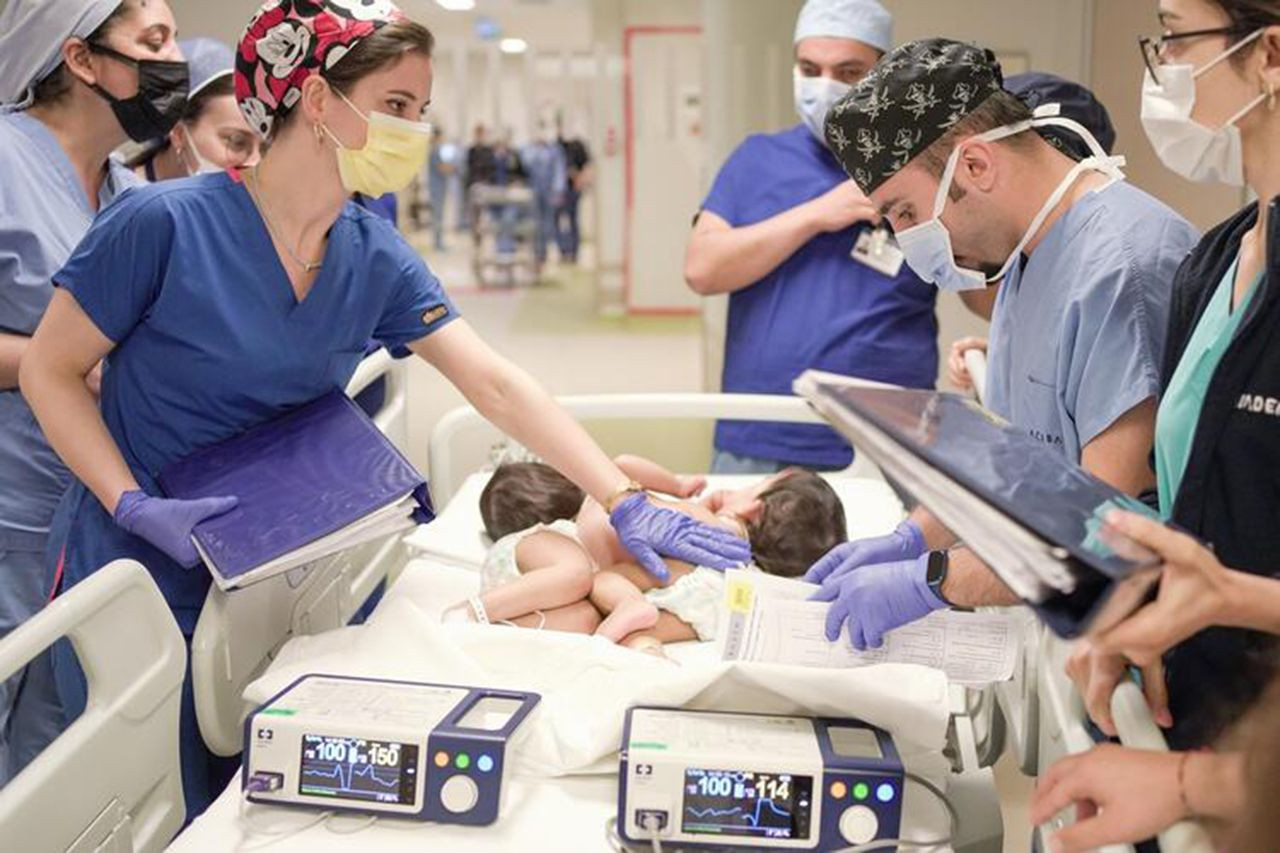 9 saat süren ameliyatla ayrıla siyam ikizlerinde son durum - Resim: 1