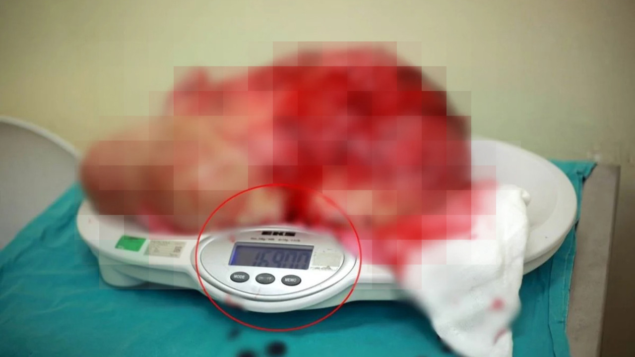 Ameliyatta 40 yıllık doktoru şaşkına çeviren olay: Kıyafetleriniz küçük geliyorsa nedeni bu olabilir