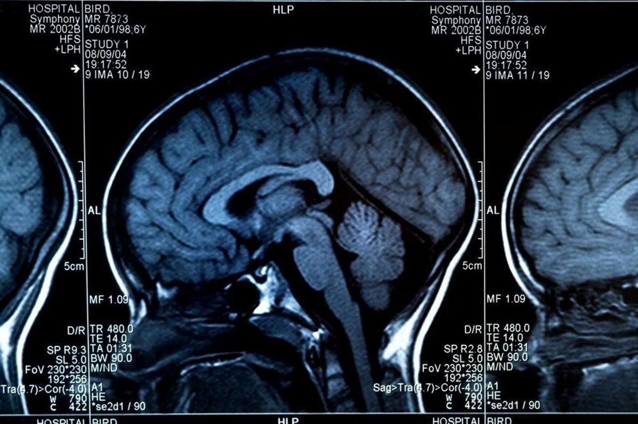 Alzheimer riskini düşürmenin en basit yolu açıklandı - Resim: 2
