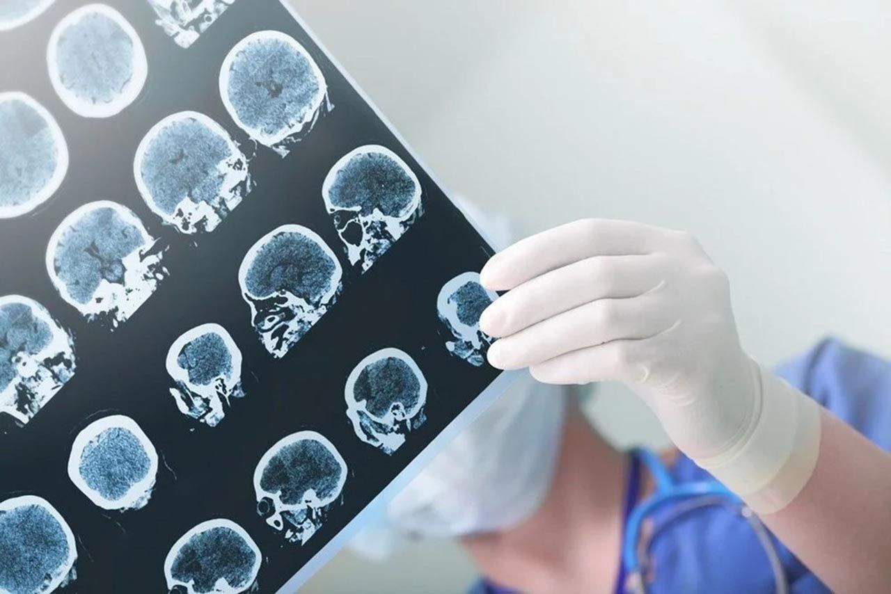 Alzheimer riskini düşürmenin en basit yolu açıklandı - Resim: 1