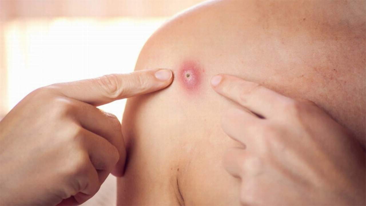 Yeni kabusumuz Maymun Çiçeği Virüsü yatak odalarını vuracak