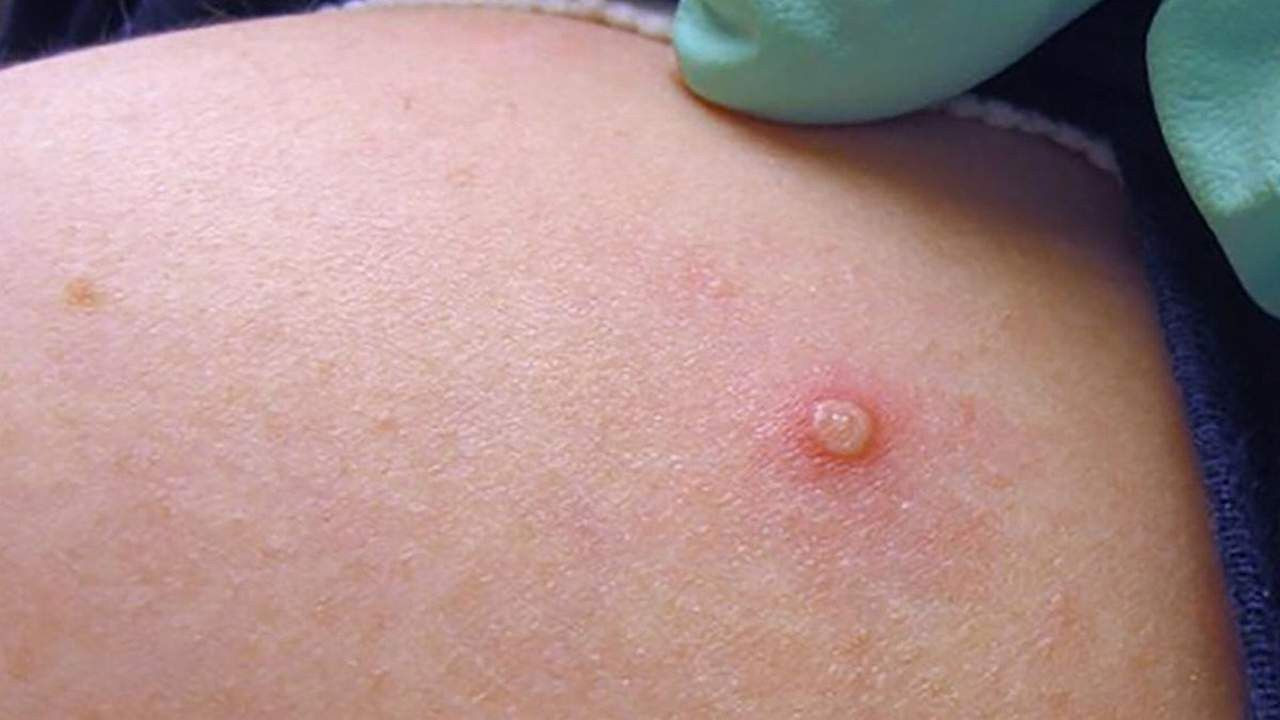 Yeni kabusumuz Maymun Çiçeği Virüsü yatak odalarını vuracak - Resim: 3