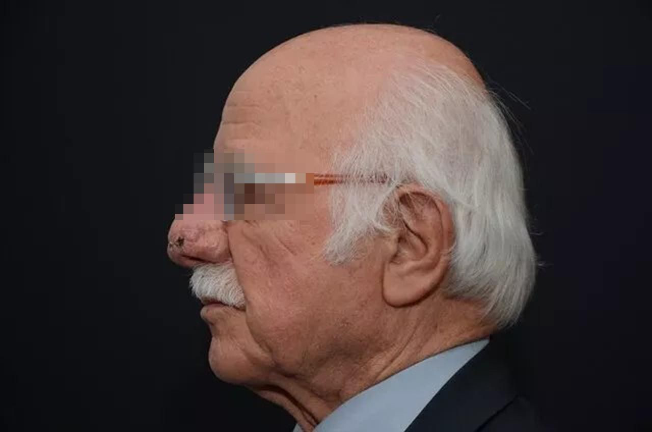 2 yıl önce oluşmaya başladı, burnu bu hale geldi - Resim: 2