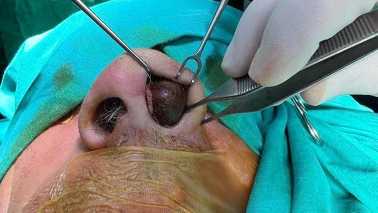 Burnundan öyle bir şey çıktı ki... 50 yıl sonra rahat nefes aldı