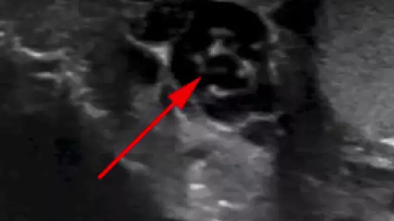 Sivrisinek ısırığı hayatını kabusa çevirdi! Doktorlar ultrason sonuçlarına inanamadı