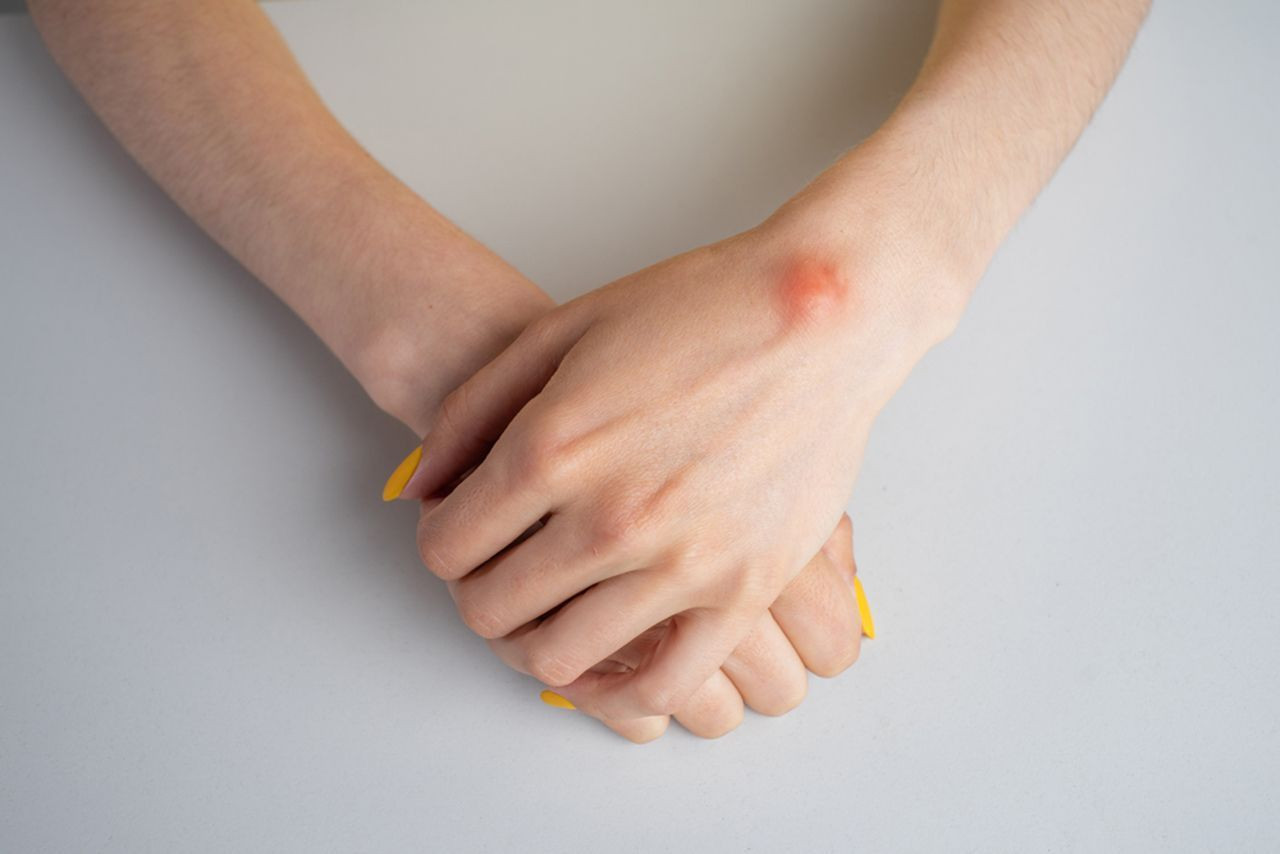 ''Ganglion kisti''nin en çok görüldüğü meslekler açılklandı - Resim: 1