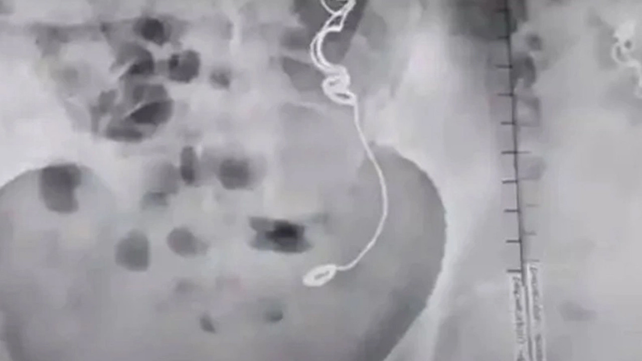 Sonuçlar doktorları bile şaşırttı! 11 sene midesinde onlarla yaşamış