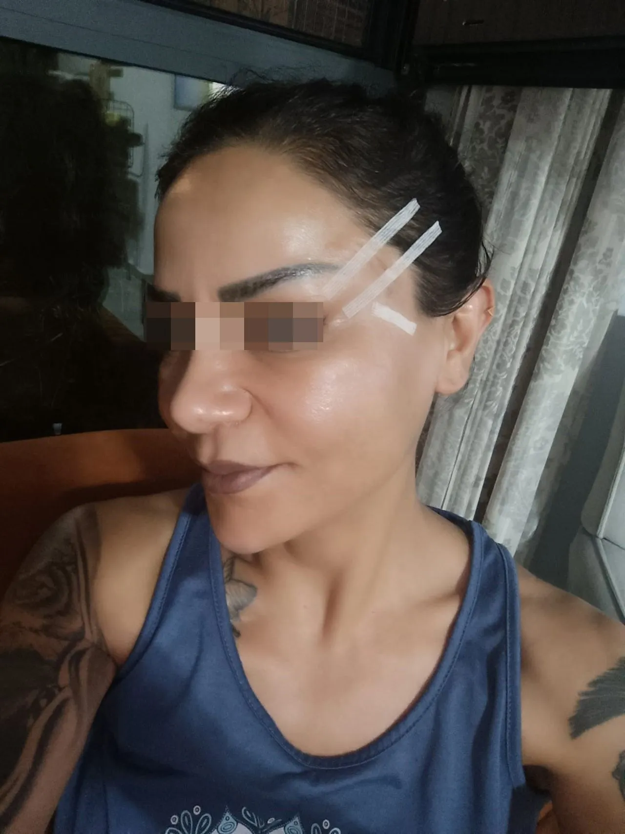 Bir estetik mağduru daha... Hem 200 bin TL'sinden oldu hem de...